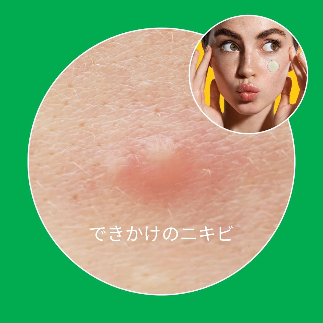 ノラアワー スポットイレイザー グリーン マイクロニードルパッチ ティーツリー葉油 マデカソシド シカ ニキビパッチ 9枚入り にきびパッチ マイクロニードル ニキビ 吹き出物