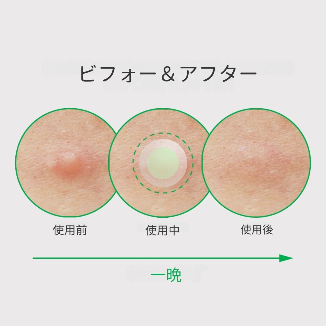 ノラアワー スポットイレイザー グリーン マイクロニードルパッチ ティーツリー葉油 マデカソシド シカ ニキビパッチ 9枚入り にきびパッチ マイクロニードル ニキビ 吹き出物